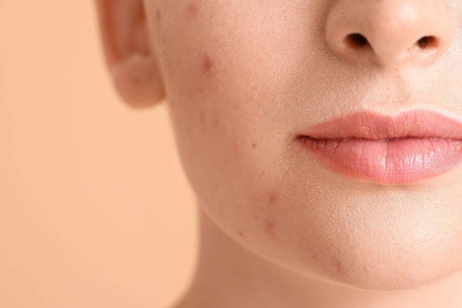 Acne Hormonal Entenda As Causas Correio Do Estado