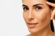 Beleza B+: Como tratar manchas e melasma com segurança e eficácia. Confira!