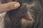 Crian&ccedil;a &eacute; socorrida ao ser atingida de rasp&atilde;o por bala perdida na cabe&ccedil;a