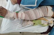 Mulher sofre fratura em assalto e ainda enfrenta drama em UPA