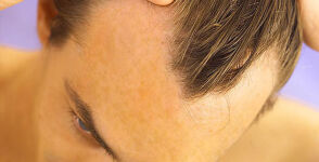 Frente contra a calvice: cientistas fazem crescer cabelo em laborat&oacute;rio 