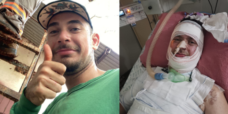 Paciente que teve o corpo queimado aguarda há cinco meses por exame