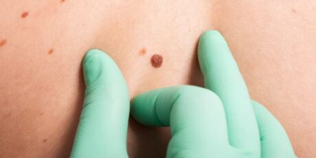 Campanha contra o c&acirc;ncer de pele leva atendimento gratuito em Mato Grosso do Sul