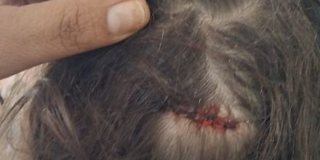 Crian&ccedil;a &eacute; socorrida ao ser atingida de rasp&atilde;o por bala perdida na cabe&ccedil;a