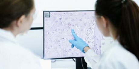 Como funciona o novo medicamento para pacientes com linfoma n&atilde;o Hodgkin agressivo
