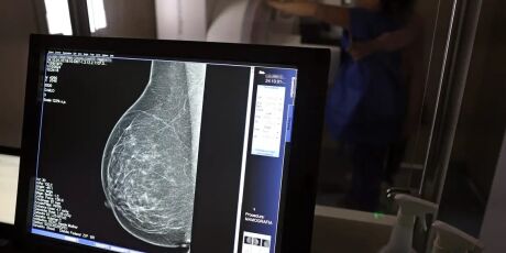Plano de sa&uacute;de ter&aacute; que cobrir mamografia digital para todas as idades