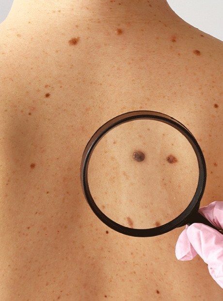 Saiba como se prevenir contra o c&acirc;ncer de pele