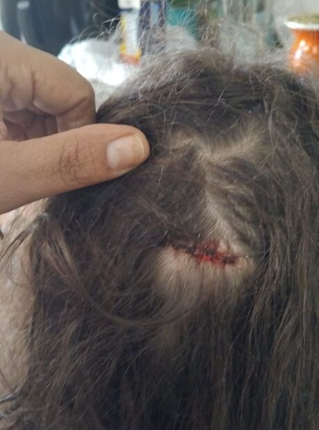Crian&ccedil;a &eacute; socorrida ao ser atingida de rasp&atilde;o por bala perdida na cabe&ccedil;a