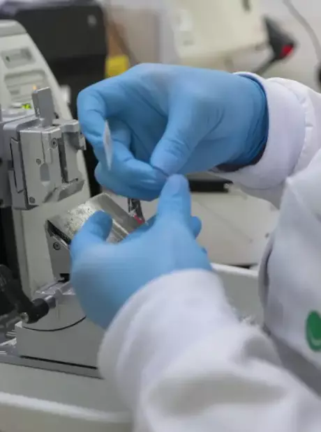 SUS disponibiliza novo tratamento para leucemia mieloide em adultos; entenda