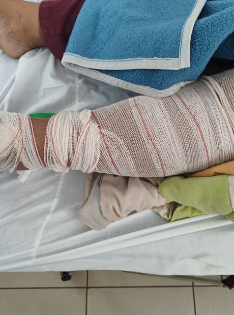 Mulher sofre fratura em assalto e ainda enfrenta drama em UPA