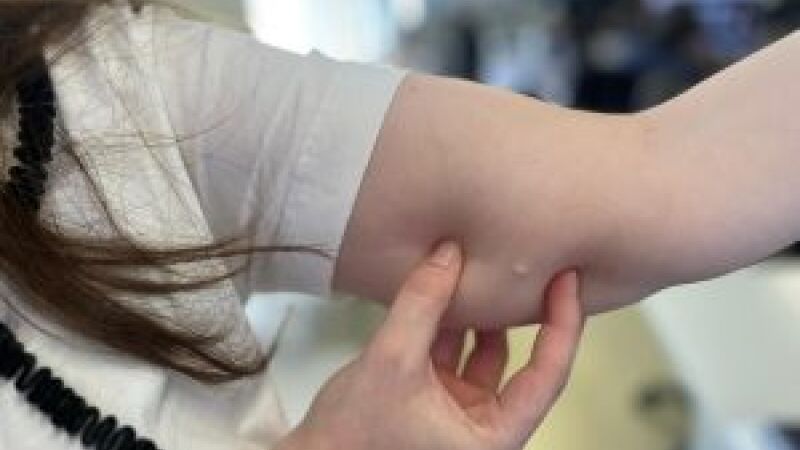 SES atribui queda à ampliação do oferecimento de LARCS na rede pública de MS