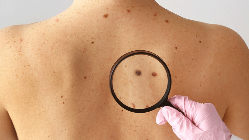 A estimativa para este ano é de que o Brasil registre 220.490 novos casos de câncer de pele não melanoma, além de 8.980 novos casos de melanoma, o tipo mais agressivo
