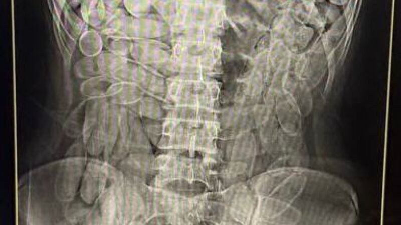 Cada uma das bolivianas engoliu 102 cápsulas de pasta base de cocaína