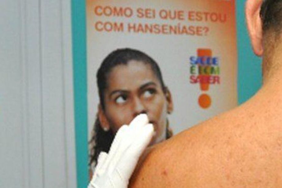 Tratamento correto impede sequelas em pacientes diagnosticados com  hanseníase - Cidades - Campo Grande News