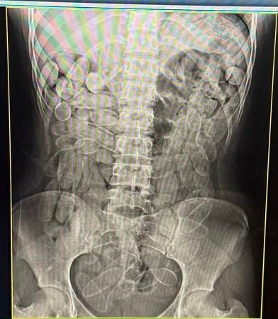 No dia 14 de janeiro, bolivianas foram presos com 102 c&aacute;psulas de coca&iacute;na no est&ocirc;mago