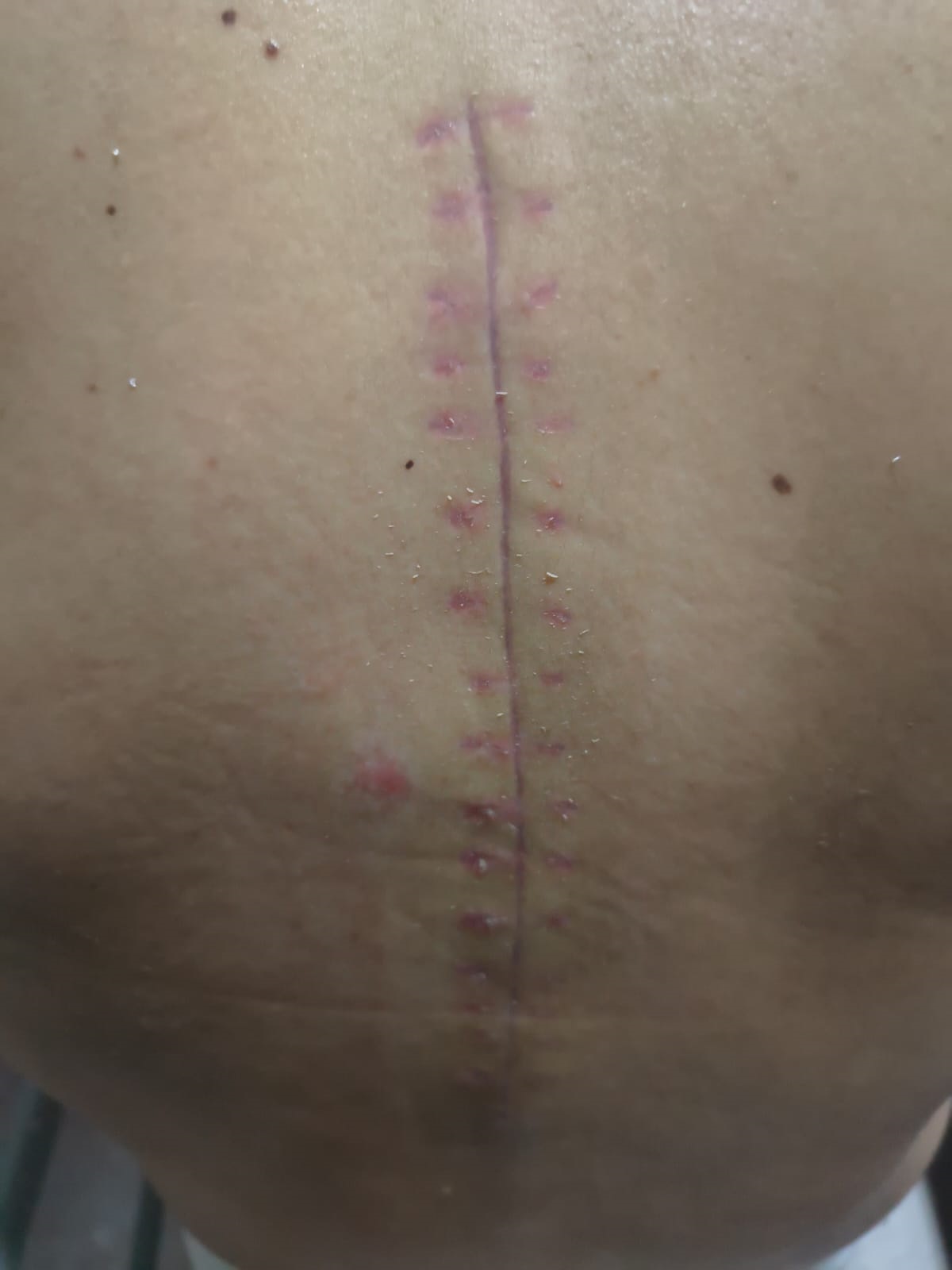 Local da cirurgia ap&oacute;s sofrer o acidente de trabalho, em dezembro